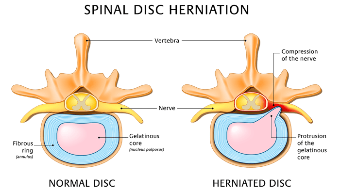 Schema herniated disc