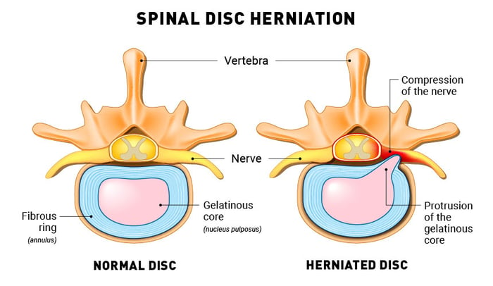 Schema herniated disc